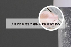 人头上长癣是怎么回事 头上长癣该怎么办