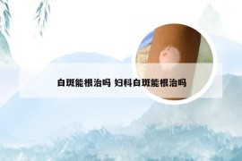 白斑能根治吗 妇科白斑能根治吗