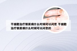 干细胞治疗银屑病什么时候可以问世 干细胞治疗银屑病什么时候可以问世的