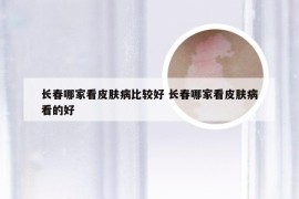 长春哪家看皮肤病比较好 长春哪家看皮肤病看的好