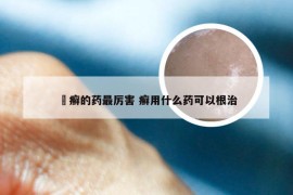 摖癣的药最厉害 癣用什么药可以根治