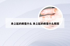 身上起的癣是什么 身上起的癣是什么原因