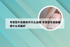 寻常型牛皮癣食疗什么治理 寻常型牛皮肤癣用什么药最好