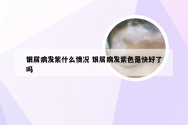 银屑病发紫什么情况 银屑病发紫色是快好了吗