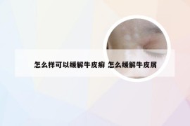 怎么样可以缓解牛皮癣 怎么缓解牛皮屑