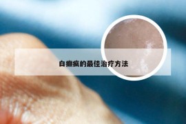 白癫疯的最佳治疗方法