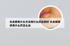 头皮癣有什么方法用什么药比较好 头皮癣症状用什么药怎么治