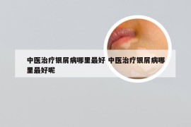 中医治疗银屑病哪里最好 中医治疗银屑病哪里最好呢