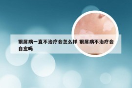 银屑病一直不治疗会怎么样 银屑病不治疗会自愈吗