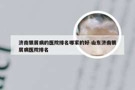 济南银屑病的医院排名哪家的好 山东济南银屑病医院排名