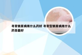 寻常银屑病用什么药好 寻常型银屑病用什么药膏最好