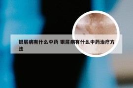 银屑病有什么中药 银屑病有什么中药治疗方法