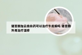 猪苦胆加云南白药可以治疗牛皮癣吗 猪苦胆外用治疗湿疹