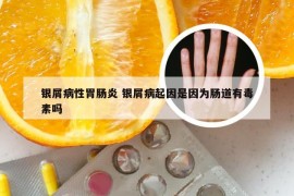 银屑病性胃肠炎 银屑病起因是因为肠道有毒素吗