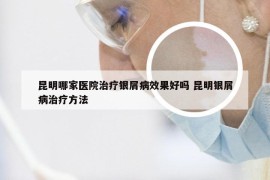 昆明哪家医院治疗银屑病效果好吗 昆明银屑病治疗方法