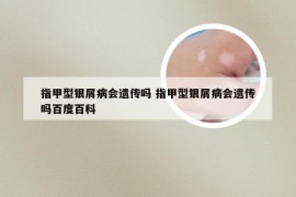 指甲型银屑病会遗传吗 指甲型银屑病会遗传吗百度百科