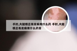 手肘,大腿根总有皮癣用什么药 手肘,大腿根总有皮癣用什么药膏