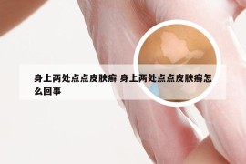 身上两处点点皮肤癣 身上两处点点皮肤癣怎么回事