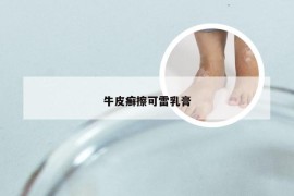 牛皮癣擦可雷乳膏