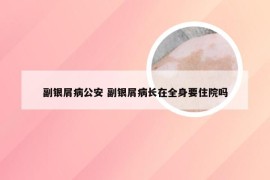 副银屑病公安 副银屑病长在全身要住院吗