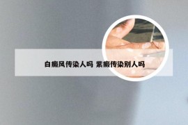 白癜风传染人吗 紫癜传染别人吗