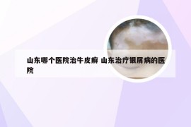 山东哪个医院治牛皮癣 山东治疗银屑病的医院