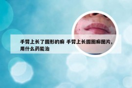 手臂上长了圆形的癣 手臂上长圆圈癣图片,用什么药能治