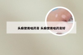 头癣使用啥药膏 头癣使用啥药膏好