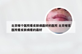 北京哪个医院看皮肤病最好的医院 北京哪家医院看皮肤病看的最好