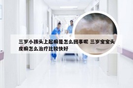 三岁小孩头上起癣是怎么回事呢 三岁宝宝头皮癣怎么治疗比较快好