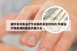 国外有没有治疗牛皮癣药膏见效快的 外国治疗银屑病的最佳药是什么