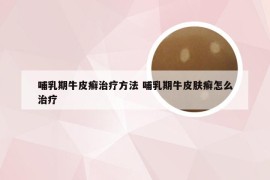 哺乳期牛皮癣治疗方法 哺乳期牛皮肤癣怎么治疗