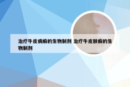 治疗牛皮病癣的生物制剂 治疗牛皮肤癣的生物制剂