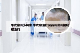 牛皮廨有多厉害 牛皮廨治疗目前有没有彻底根治的