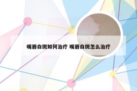 嘴唇白斑如何治疗 嘴唇白斑怎么治疗