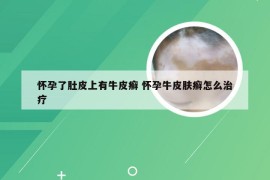 怀孕了肚皮上有牛皮癣 怀孕牛皮肤癣怎么治疗