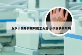 五岁小孩身有银屑病怎么治 小孩皮肤银屑病