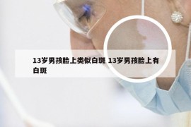 13岁男孩脸上类似白斑 13岁男孩脸上有白斑