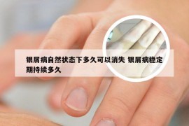 银屑病自然状态下多久可以消失 银屑病稳定期持续多久