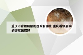 重庆市看银屑病的医院有哪些 重庆看银屑病的哪家医院好