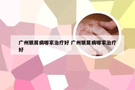 广州银屑病哪家治疗好 广州银屑病哪家治疗好