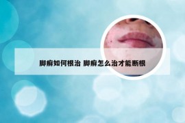 脚癣如何根治 脚癣怎么治才能断根