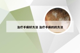 治疗手癣好方法 治疗手癣的的方法