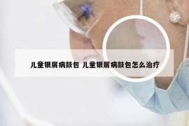 儿童银屑病鼓包 儿童银屑病鼓包怎么治疗