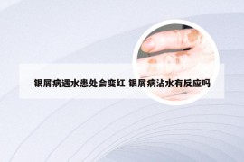 银屑病遇水患处会变红 银屑病沾水有反应吗