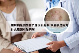 银屑病是因为什么原因引起的 银屑病是因为什么原因引起的呢