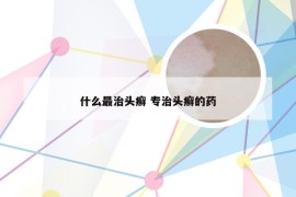 什么最治头癣 专治头癣的药