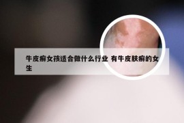 牛皮癣女孩适合做什么行业 有牛皮肤癣的女生