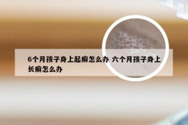 6个月孩子身上起癣怎么办 六个月孩子身上长癣怎么办