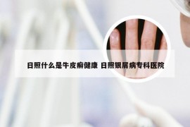 日照什么是牛皮癣健康 日照银屑病专科医院